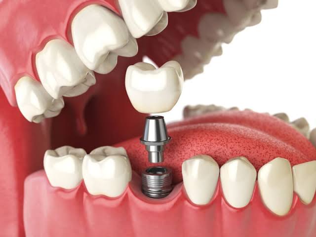 3D Digital Implant
