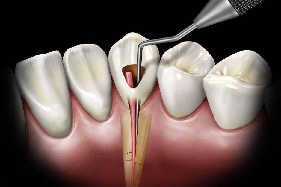Endodonti Hover