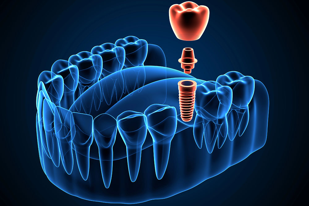 3D Digital Implant Hover